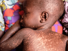 Measles outbreak confirmed in Luwero