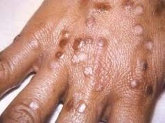 Gov’t to releases School Guideline on SmallPox prevention