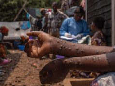 3 Mpox cases confirmed in Kasese